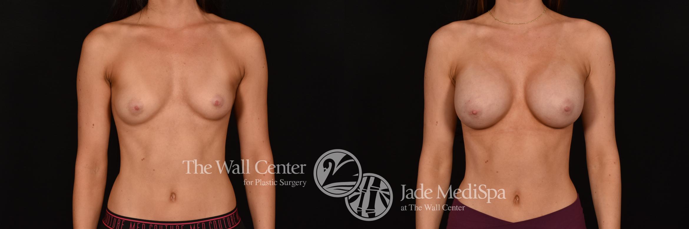 Before & After Breast Augmentation Case 1232 Front View in Shreveport, LA