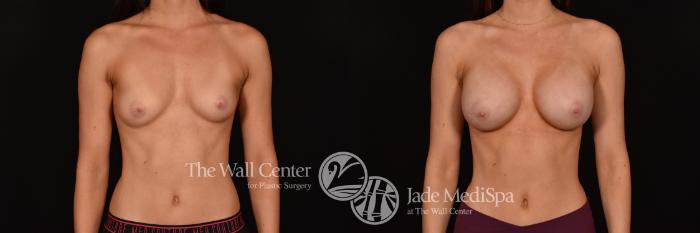 Before & After Breast Augmentation Case 1232 Front View in Shreveport, LA