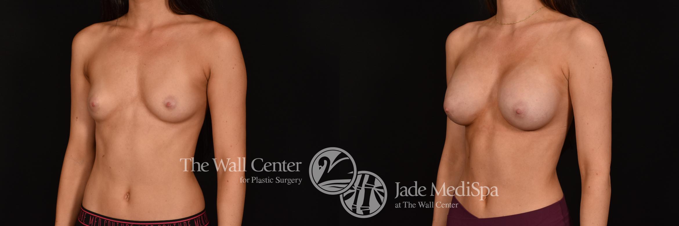 Before & After Breast Augmentation Case 1232 Left Oblique View in Shreveport, LA