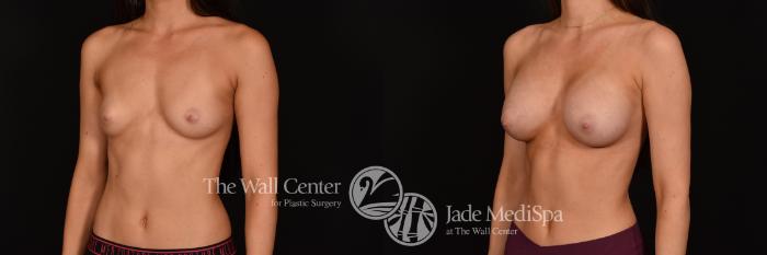 Before & After Breast Augmentation Case 1232 Left Oblique View in Shreveport, LA