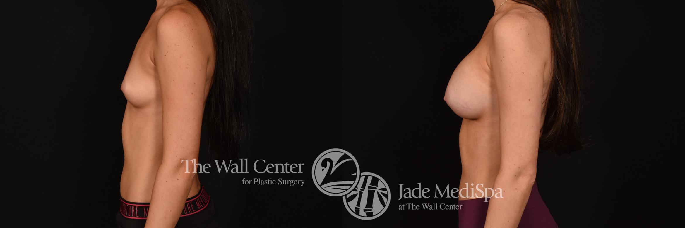 Before & After Breast Augmentation Case 1232 Left Side View in Shreveport, LA