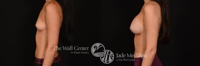 Before & After Breast Augmentation Case 1232 Left Side View in Shreveport, LA