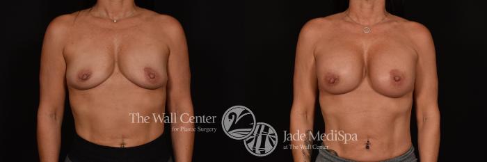 Before & After Breast Augmentation Case 1233 Front View in Shreveport, LA