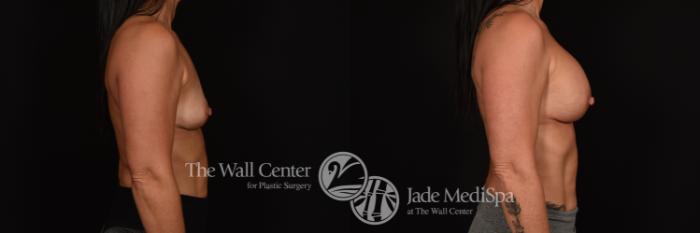Before & After Breast Augmentation Case 1233 Right Side View in Shreveport, LA