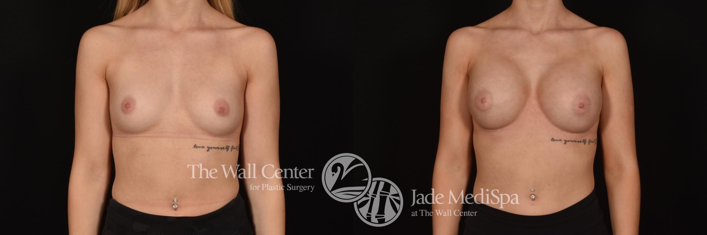 Before & After Breast Augmentation Case 1234 Front View in Shreveport, LA