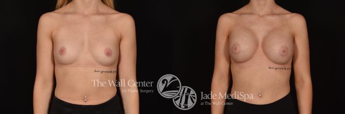Before & After Breast Augmentation Case 1234 Front View in Shreveport, LA