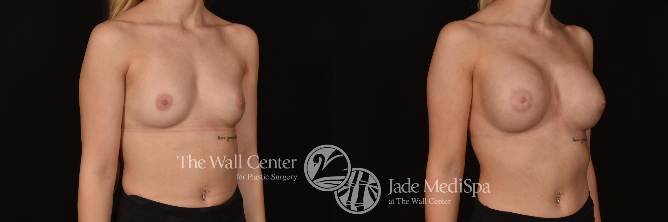 Before & After Breast Augmentation Case 1234 Right Oblique View in Shreveport, LA