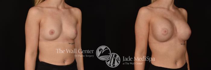 Before & After Breast Augmentation Case 1234 Right Oblique View in Shreveport, LA