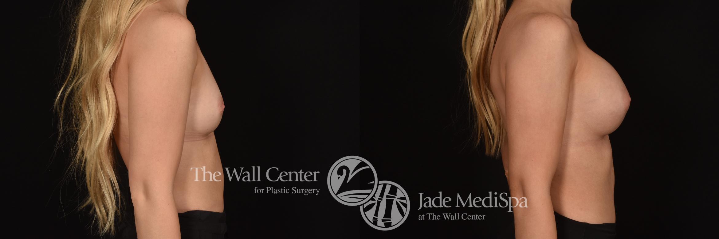 Before & After Breast Augmentation Case 1234 Right Side View in Shreveport, LA