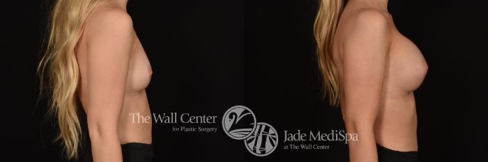Before & After Breast Augmentation Case 1234 Right Side View in Shreveport, LA