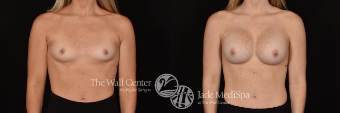 Before & After Breast Augmentation Case 1246 Front View in Shreveport, LA