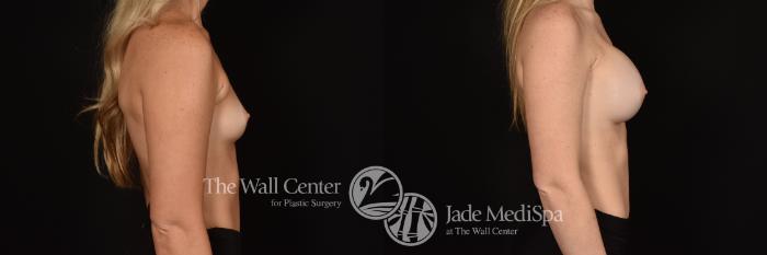 Before & After Breast Augmentation Case 1246 Right Side View in Shreveport, LA