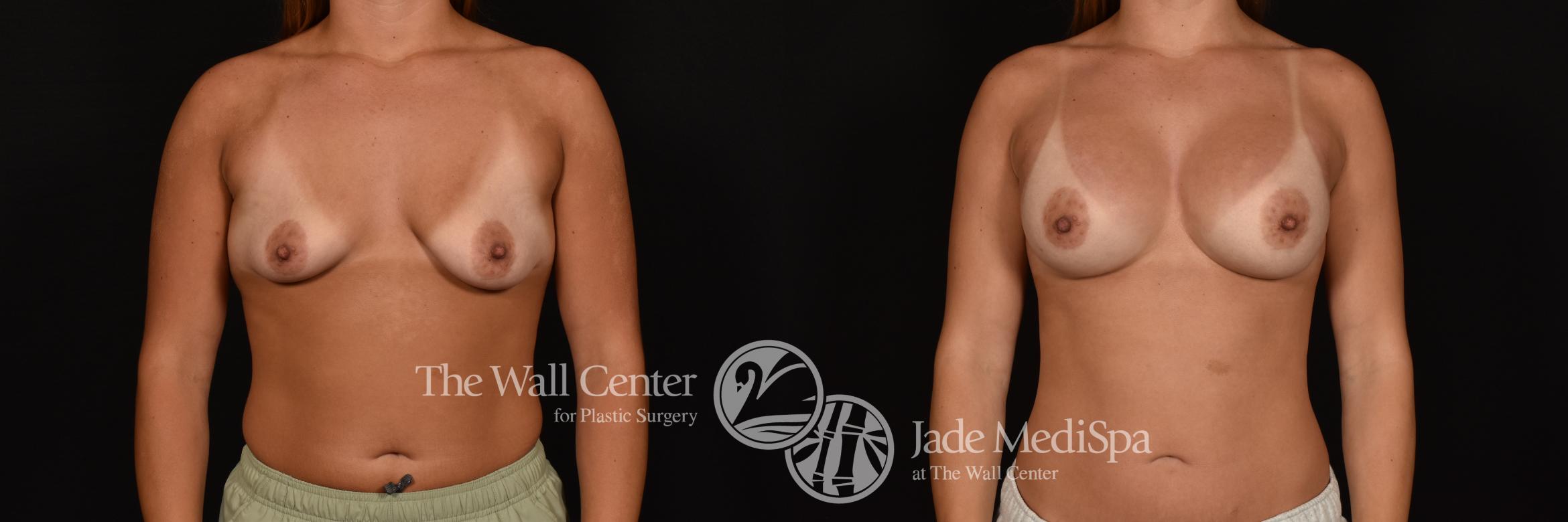 Before & After Breast Augmentation Case 1251 Front View in Shreveport, LA