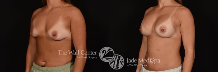 Before & After Breast Augmentation Case 1251 Left Oblique View in Shreveport, LA