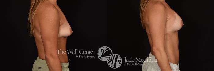 Before & After Breast Augmentation Case 1251 Right Side View in Shreveport, LA