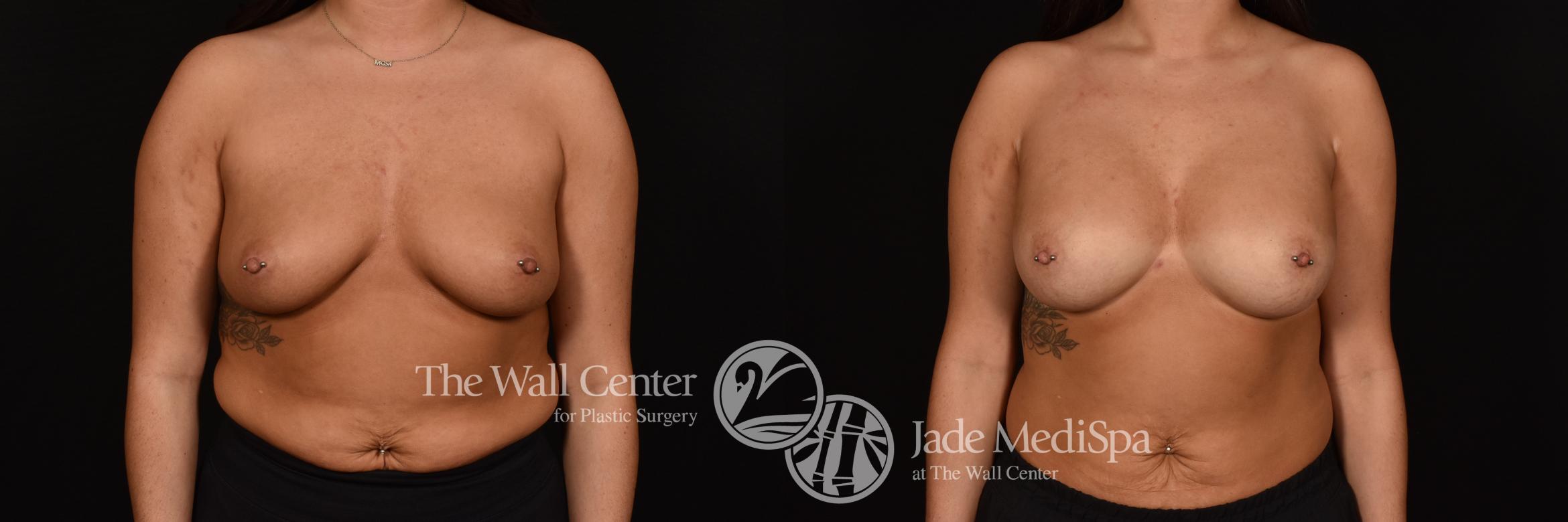 Before & After Breast Augmentation Case 1256 Front View in Shreveport, LA