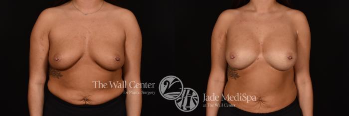 Before & After Breast Augmentation Case 1256 Front View in Shreveport, LA