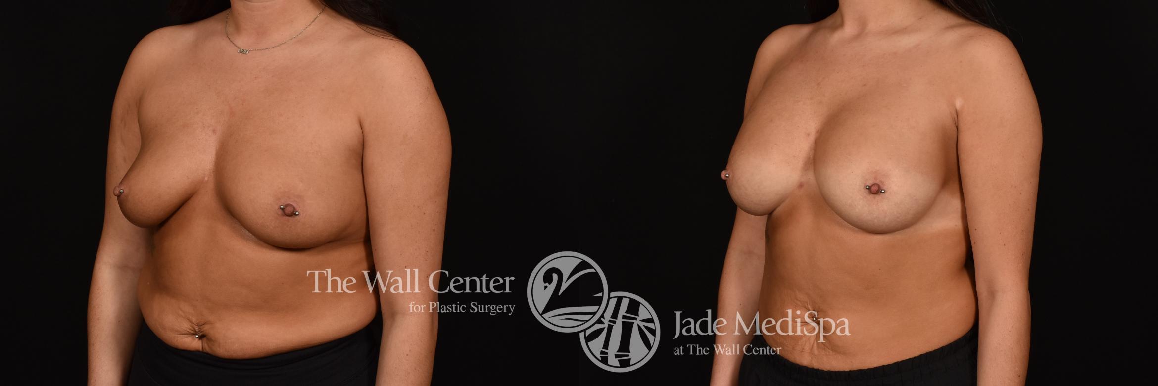 Before & After Breast Augmentation Case 1256 Left Oblique View in Shreveport, LA