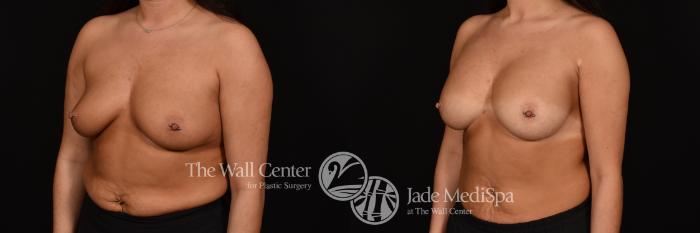 Before & After Breast Augmentation Case 1256 Left Oblique View in Shreveport, LA
