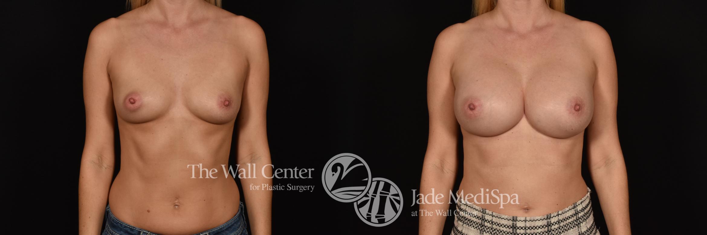 Before & After Breast Augmentation Case 1259 Front View in Shreveport, LA