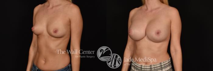 Before & After Breast Augmentation Case 1259 Left Oblique View in Shreveport, LA