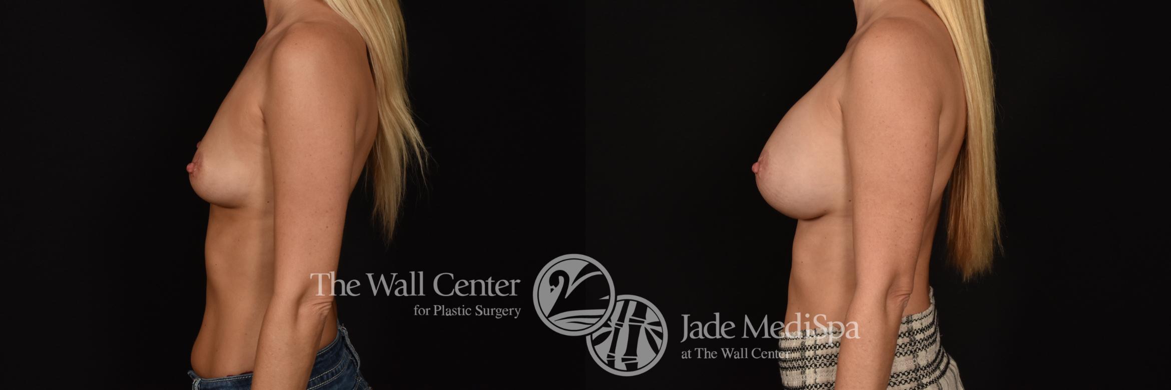 Before & After Breast Augmentation Case 1259 Left Side View in Shreveport, LA