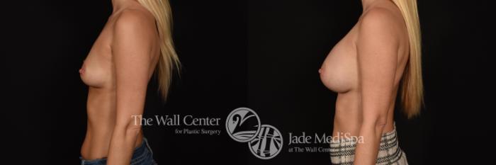 Before & After Breast Augmentation Case 1259 Left Side View in Shreveport, LA