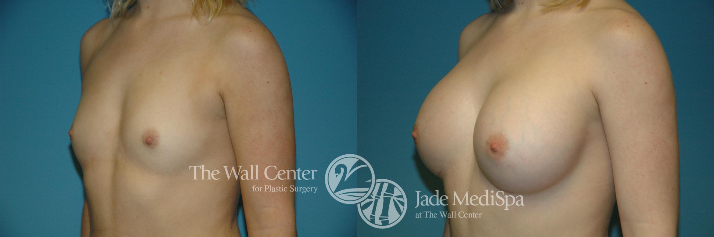 Before & After Breast Augmentation Case 193 View #2 View in Shreveport, LA