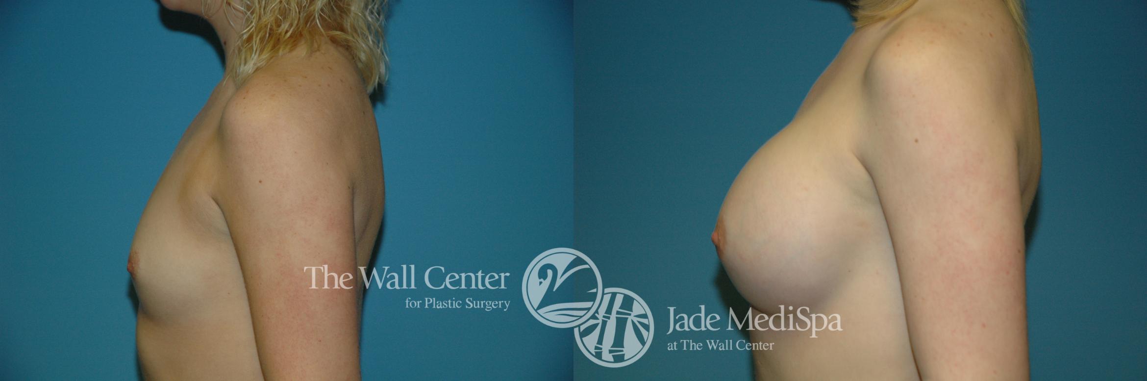 Before & After Breast Augmentation Case 193 View #3 View in Shreveport, LA