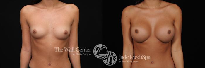 Before & After Breast Augmentation Case 264 View #1 View in Shreveport, LA