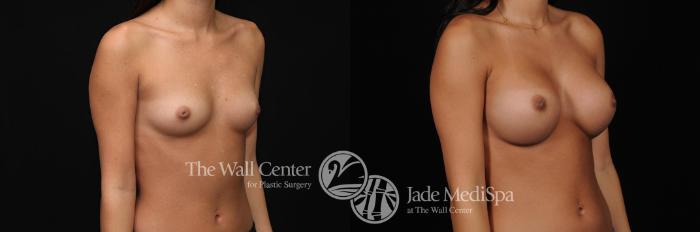 Before & After Breast Augmentation Case 264 View #2 View in Shreveport, LA