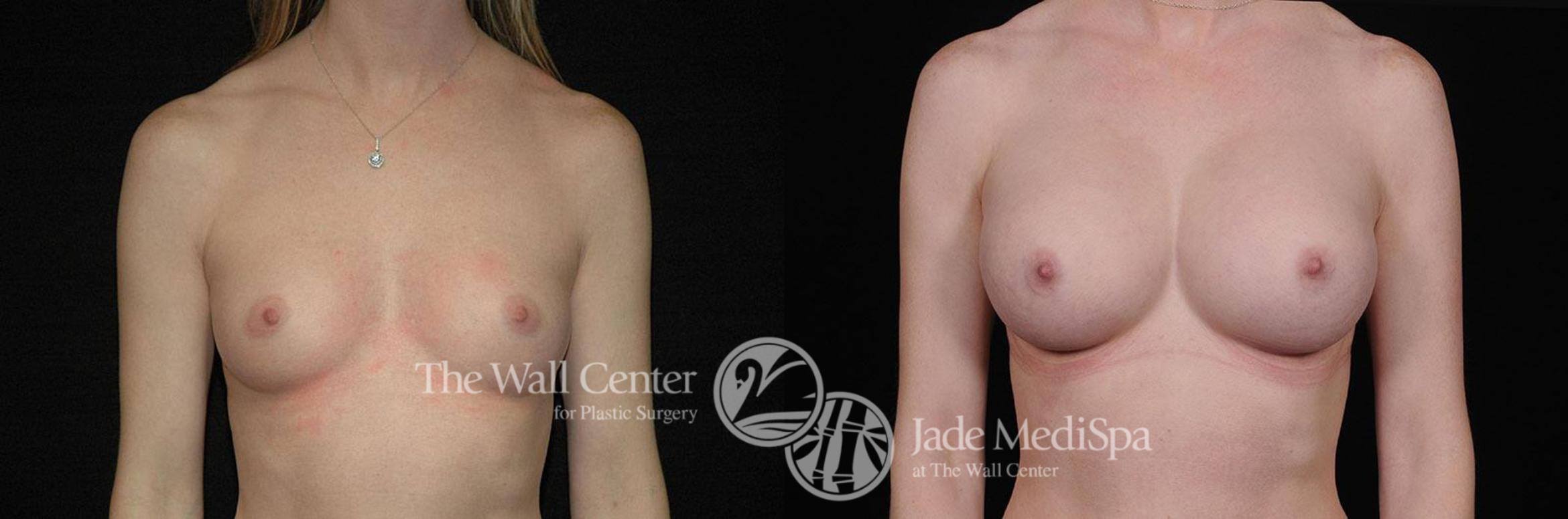 Before & After Breast Augmentation Case 265 View #1 View in Shreveport, LA