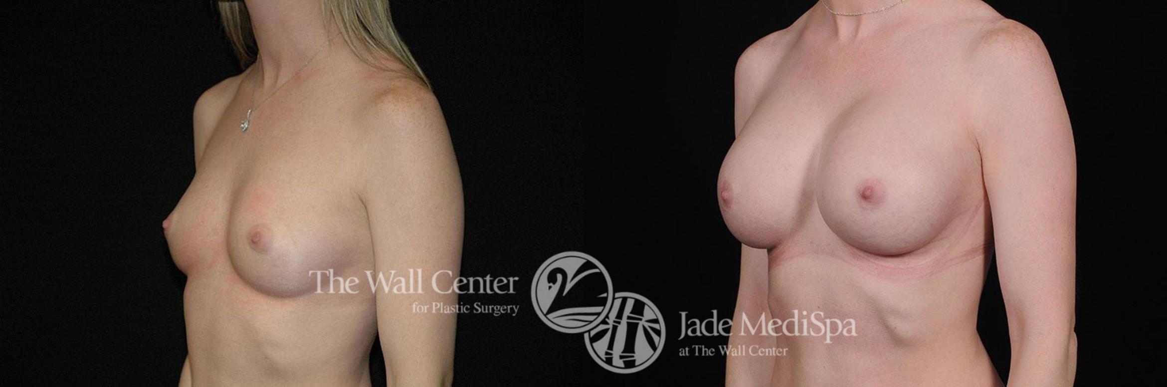 Before & After Breast Augmentation Case 265 View #2 View in Shreveport, LA