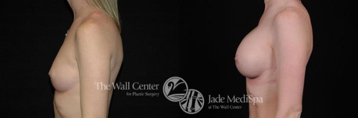 Before & After Breast Augmentation Case 265 View #3 View in Shreveport, LA