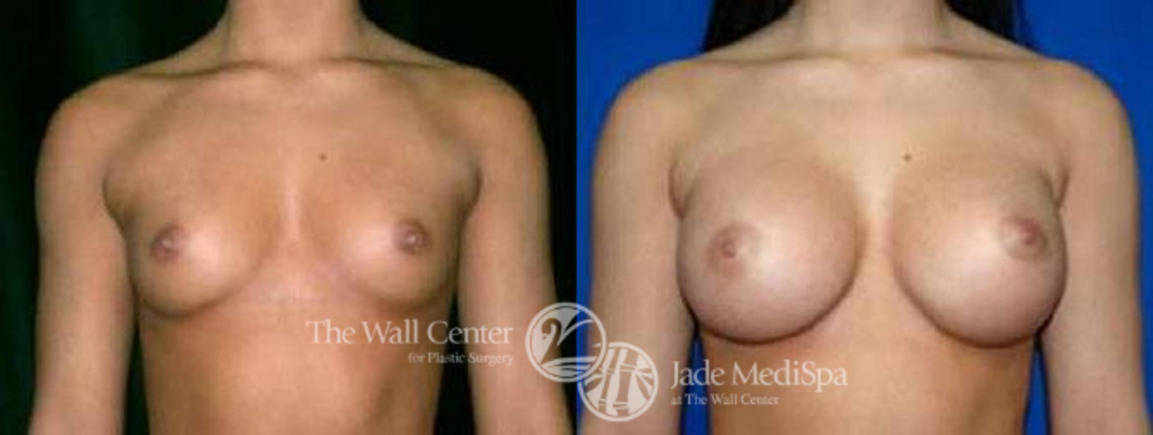 Before & After Breast Augmentation Case 27 View #1 View in Shreveport, LA