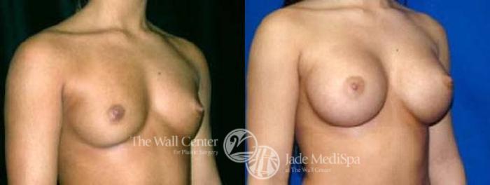 Before & After Breast Augmentation Case 27 View #2 View in Shreveport, LA