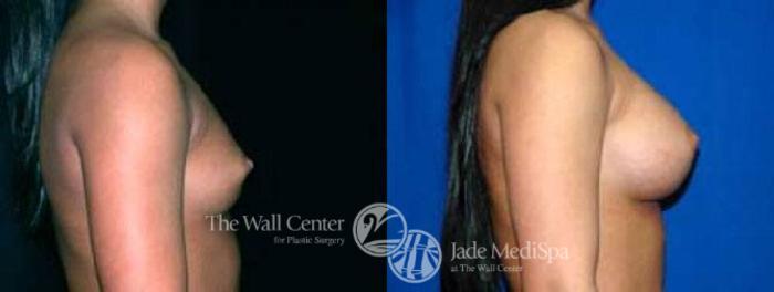Before & After Breast Augmentation Case 27 View #3 View in Shreveport, LA