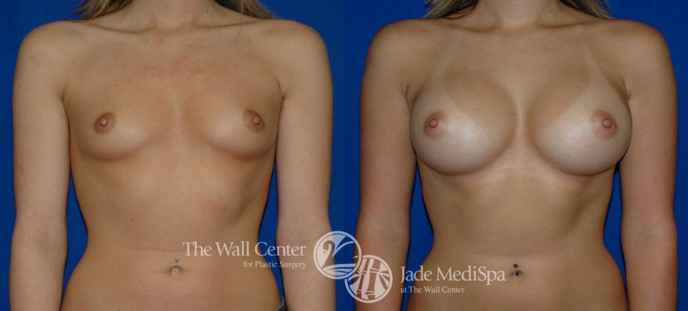 Before & After Breast Augmentation Case 271 View #1 View in Shreveport, LA