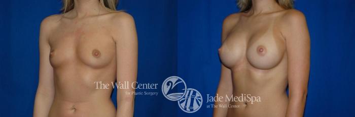 Before & After Breast Augmentation Case 271 View #2 View in Shreveport, LA