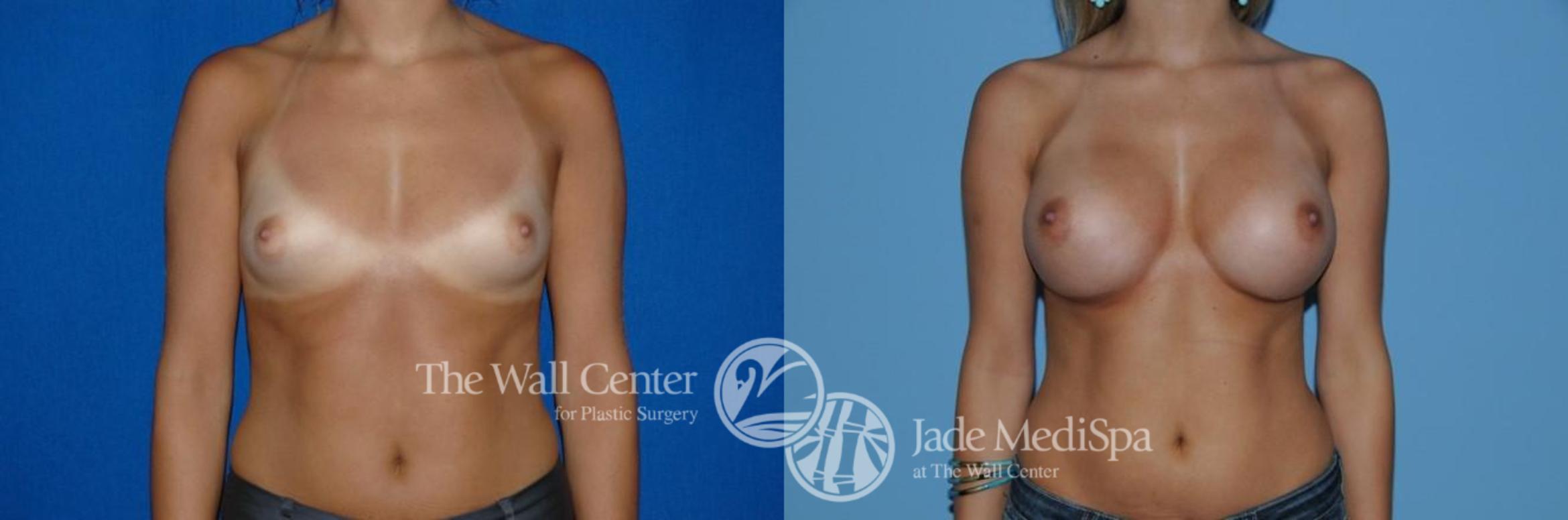 Before & After Breast Augmentation Case 275 View #1 View in Shreveport, LA