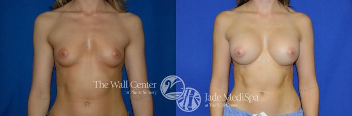 Before & After Breast Augmentation Case 277 View #1 View in Shreveport, LA