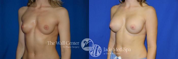 Before & After Breast Augmentation Case 277 View #2 View in Shreveport, LA