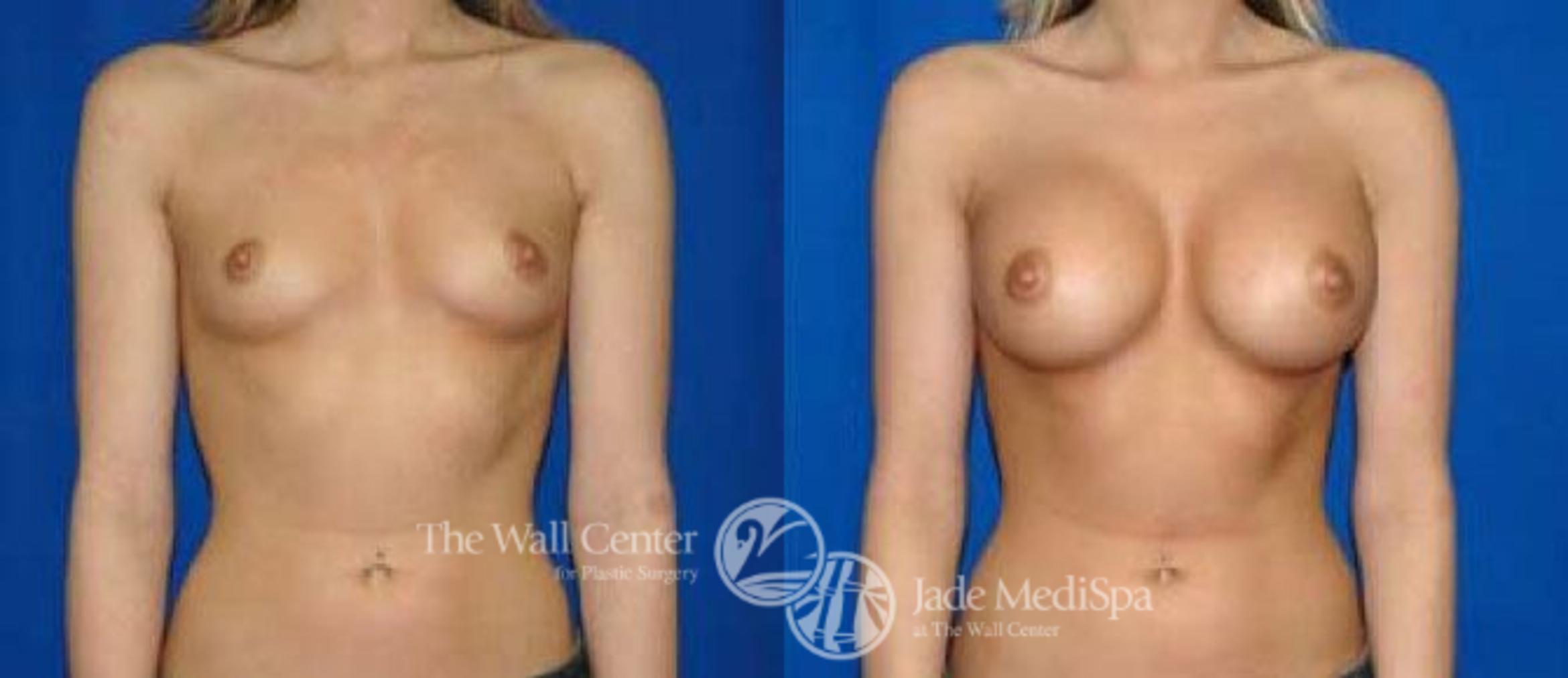 Before & After Breast Augmentation Case 28 View #1 View in Shreveport, LA