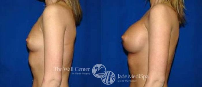 Before & After Breast Augmentation Case 28 View #3 View in Shreveport, LA