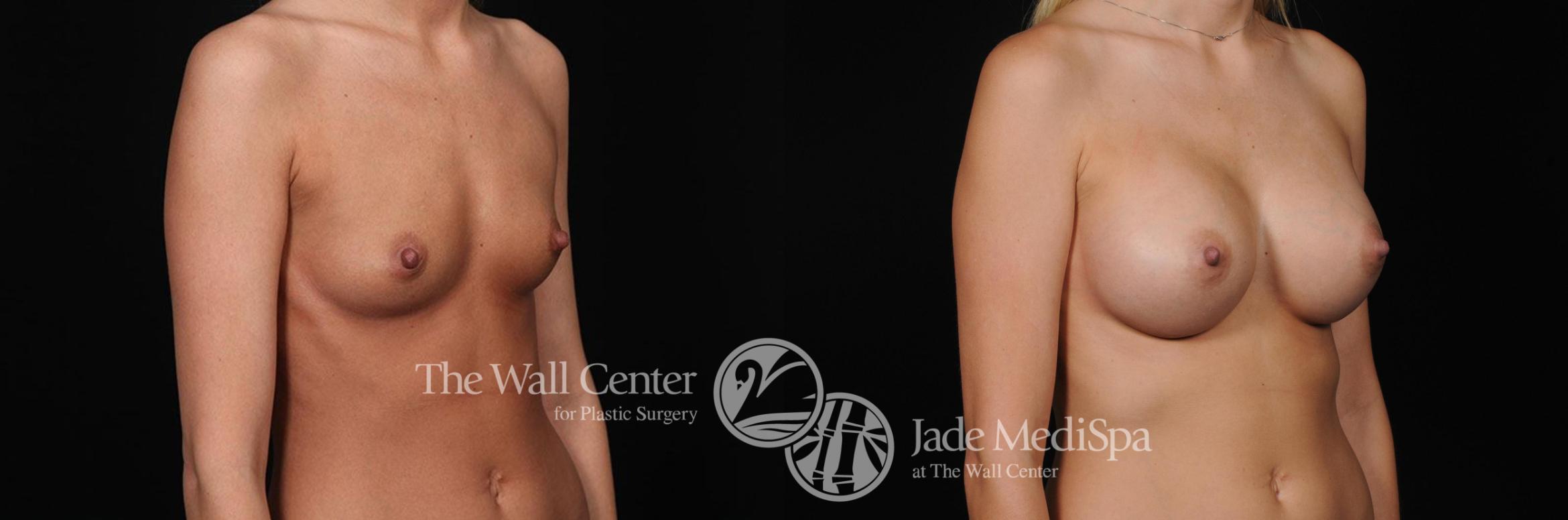Before & After Breast Augmentation Case 287 View #2 View in Shreveport, LA