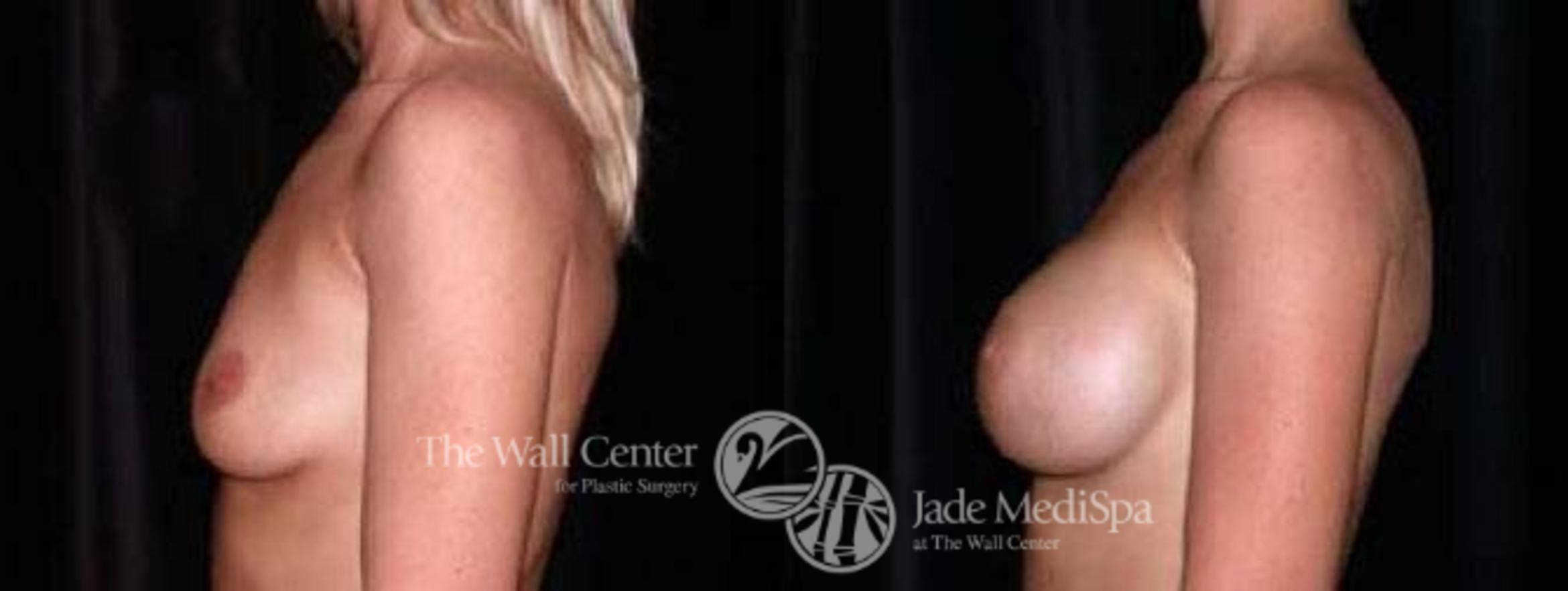 Before & After Breast Augmentation Case 29 View #3 View in Shreveport, LA