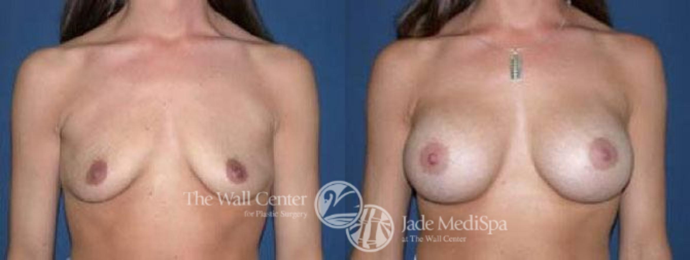 Before & After Breast Augmentation Case 30 View #1 View in Shreveport, LA