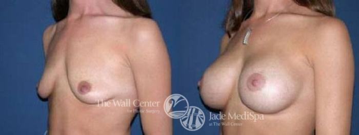 Before & After Breast Augmentation Case 30 View #2 View in Shreveport, LA