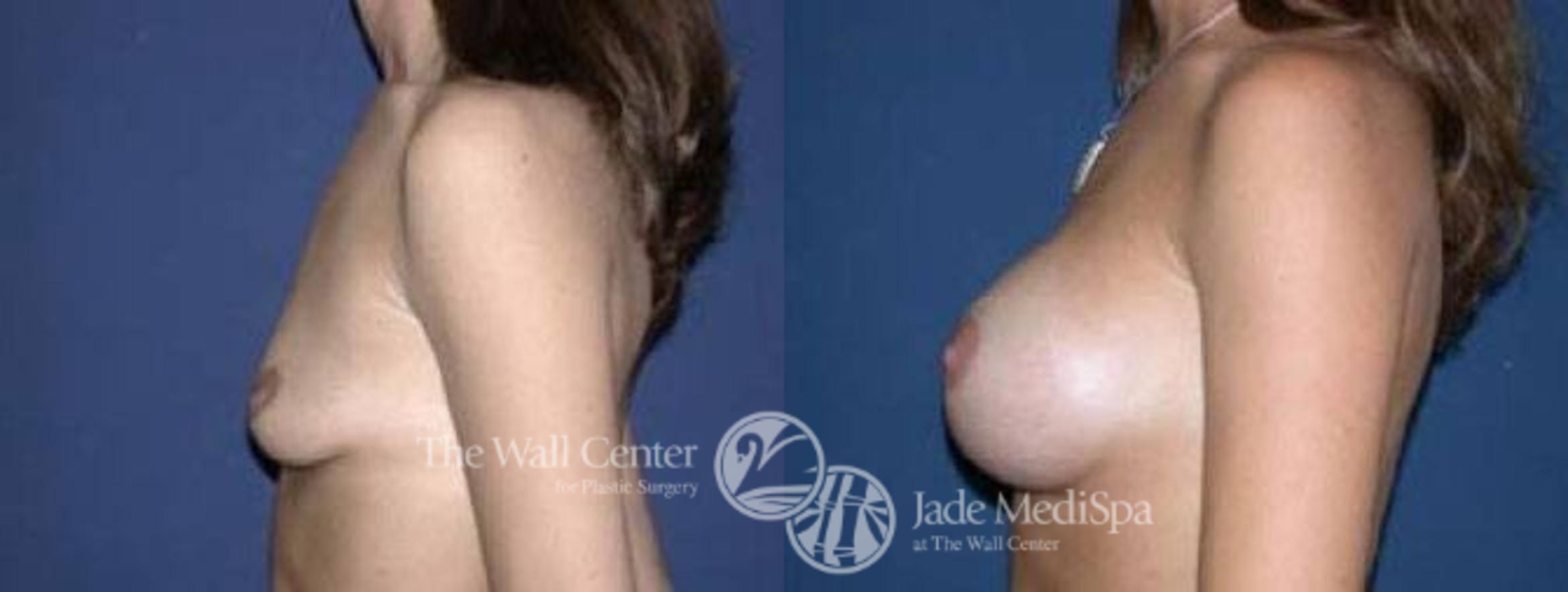 Before & After Breast Augmentation Case 30 View #3 View in Shreveport, LA