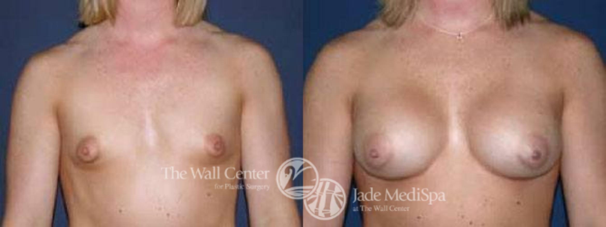 Before & After Breast Augmentation Case 38 View #1 View in Shreveport, LA